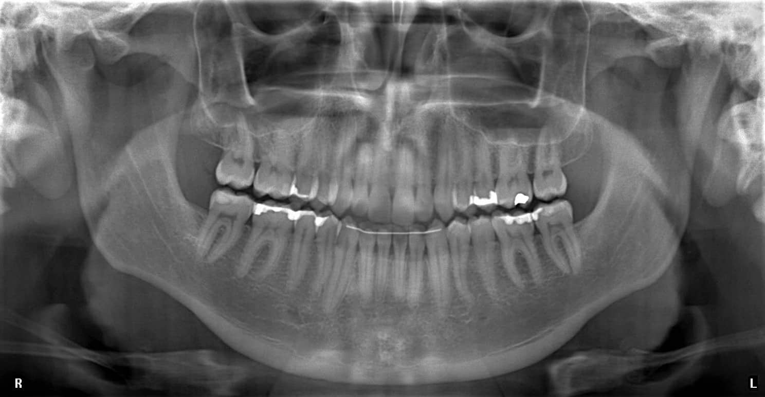 Panoramic radiograph sent in for a dental radiology report because of potential pathology.