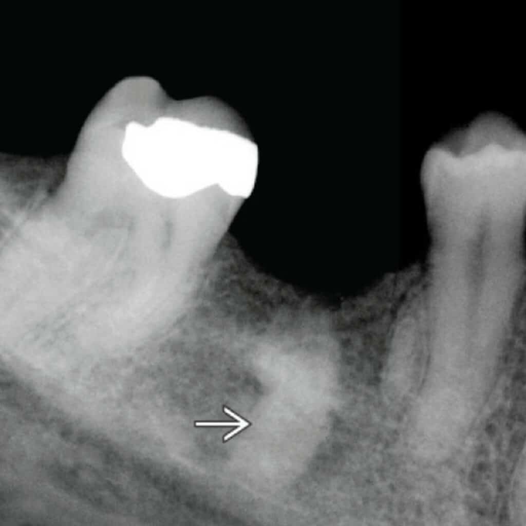 Dense Bone Island (Diagnostic Imaging Oral and Maxillofacial - Lisa Koenig)