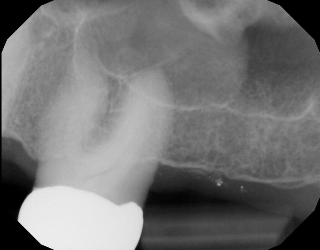 Mucous Retention Pseudocyst