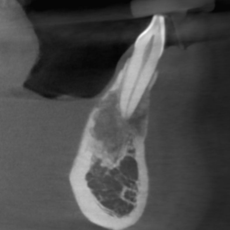 Tooth with granular radiolucency at root apex.