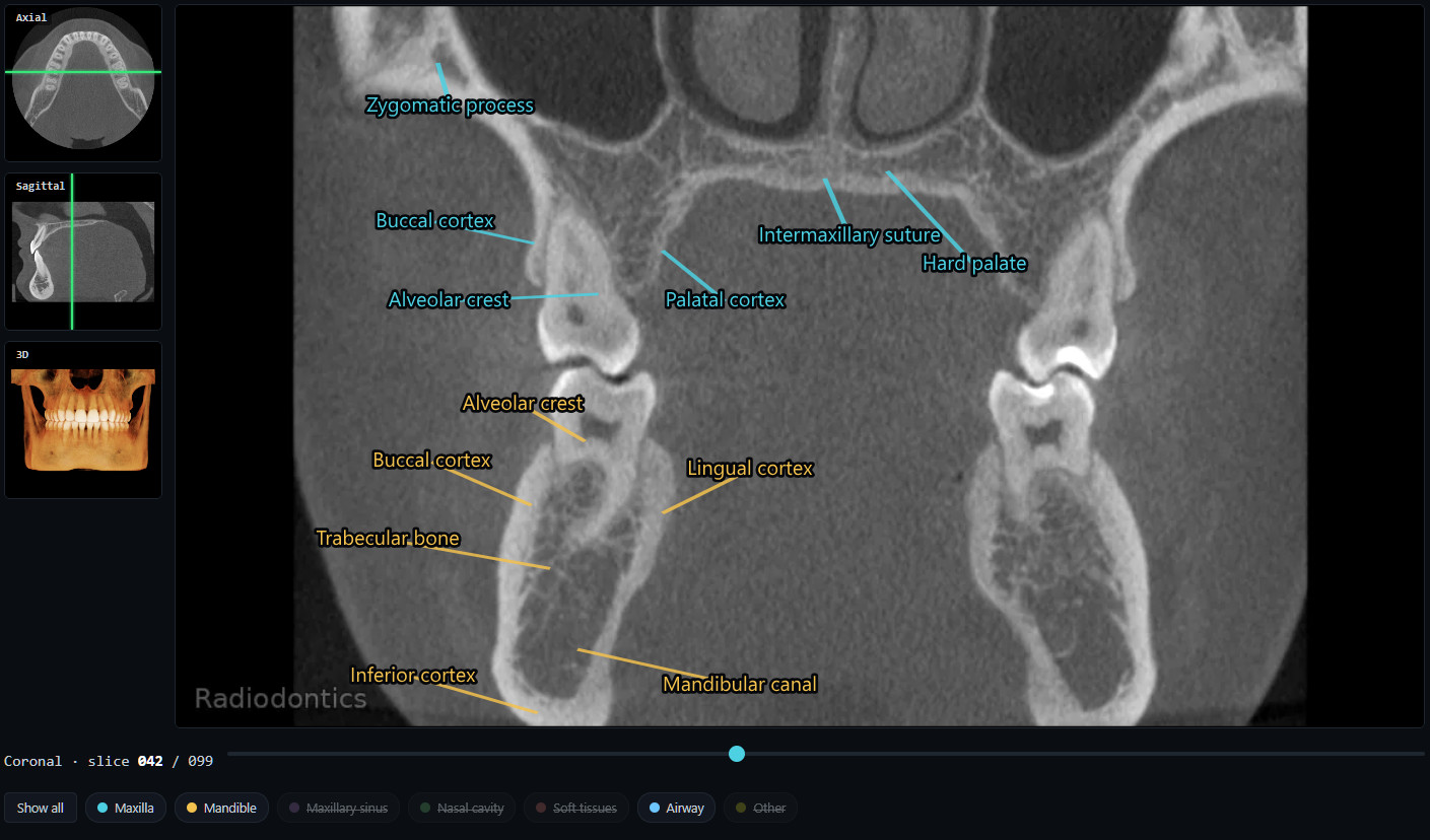 Coronal CBCT Anatomy